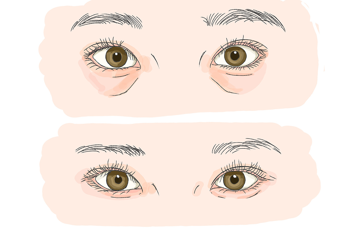 第5章 クマ取りで涙袋は出る?