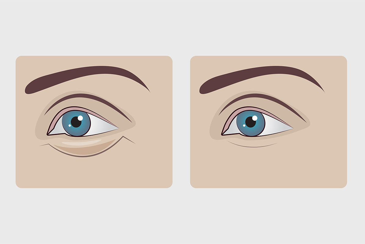 第4章 施術別のダウンタイムの期間と症状の違い