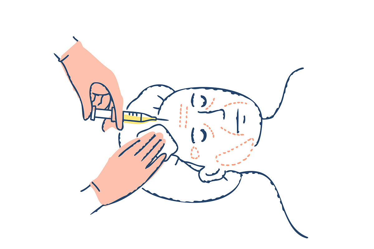 3-3. 治療法②：「脱脂＋脂肪注入」