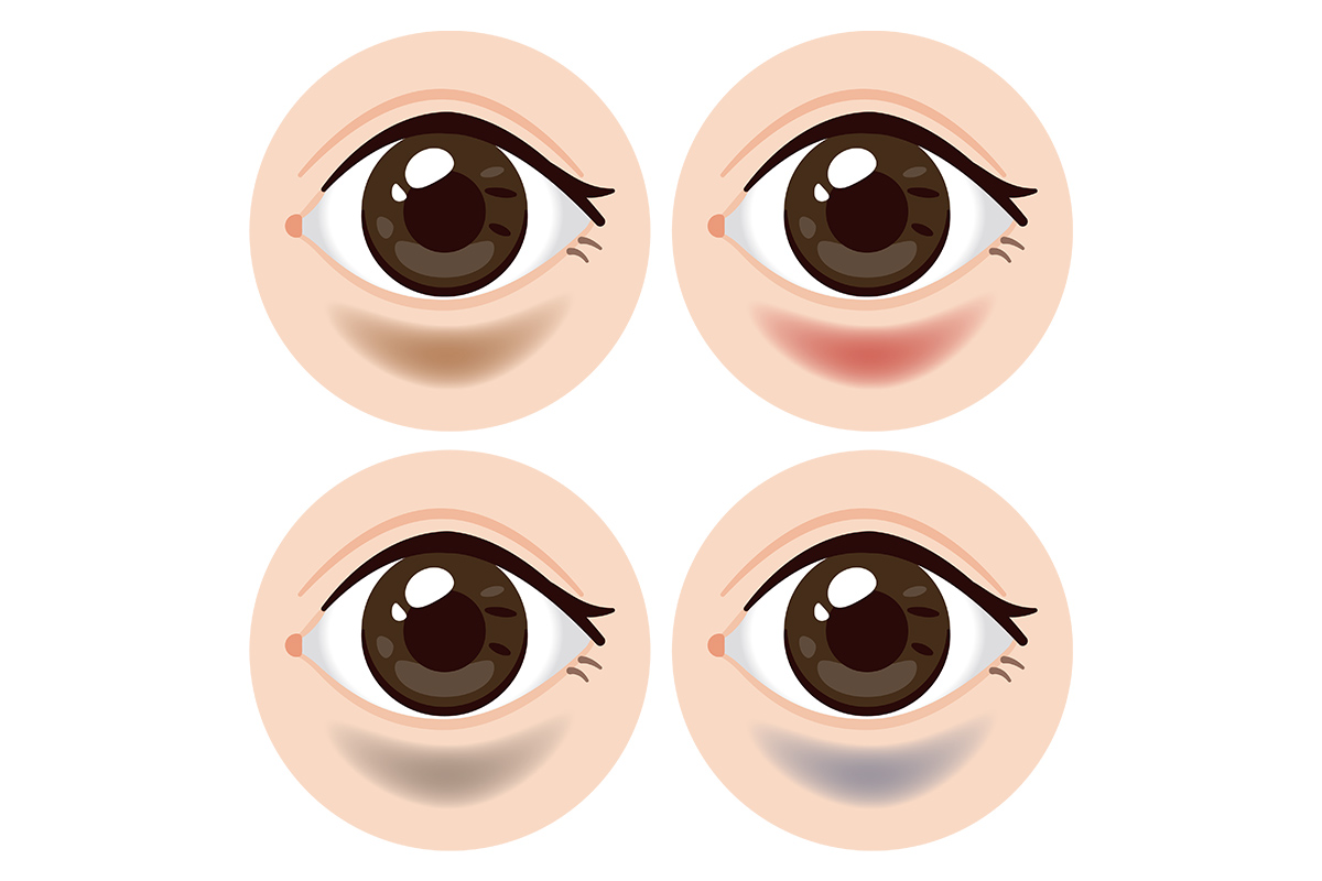 第2章 ダウンタイム中の腫れと内出血はいつまで?