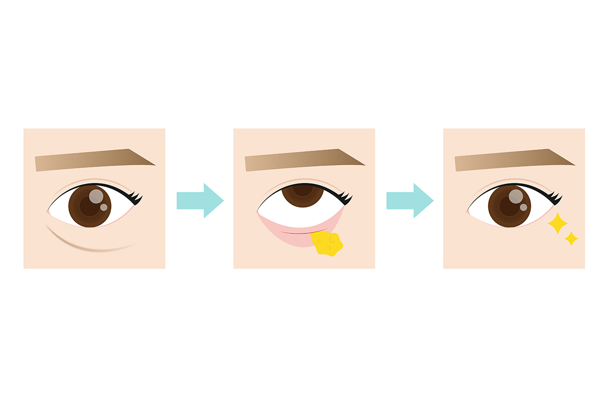 3-2. 涙袋を残してクマだけを改善することは可能?