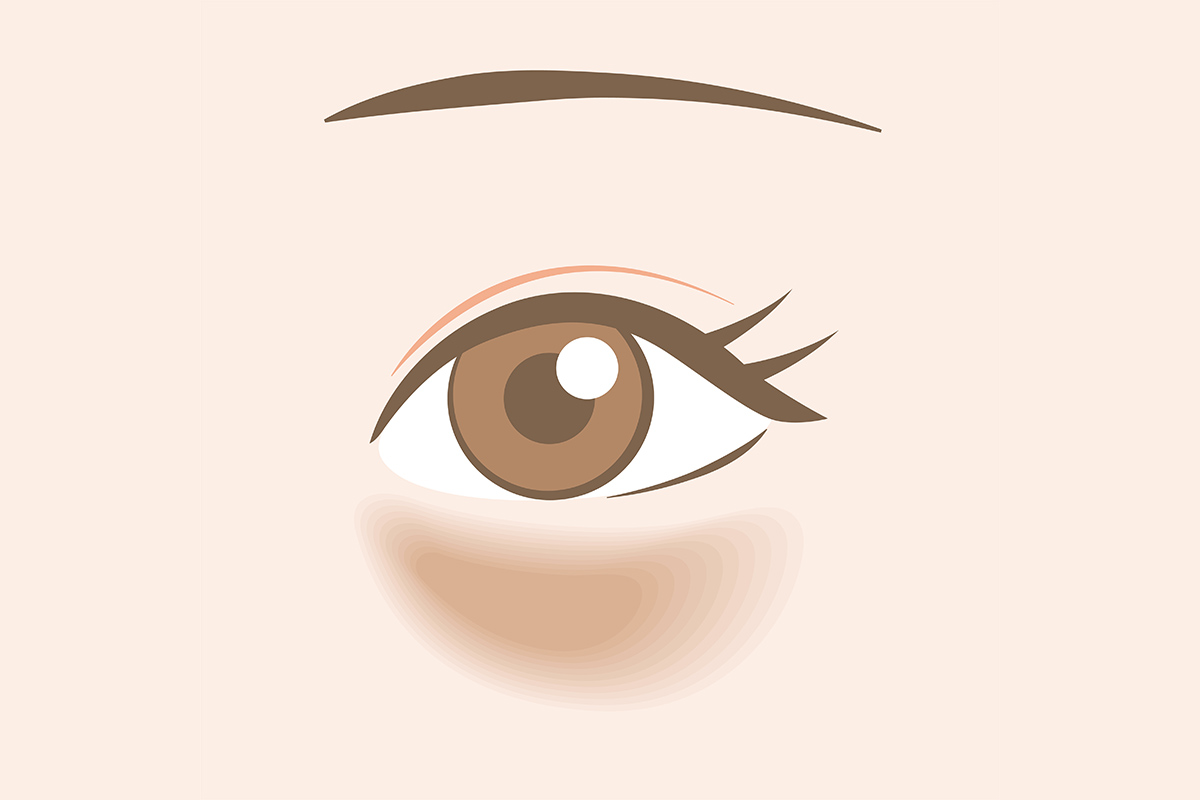 第1章 クマ治療における脂肪注入とは？