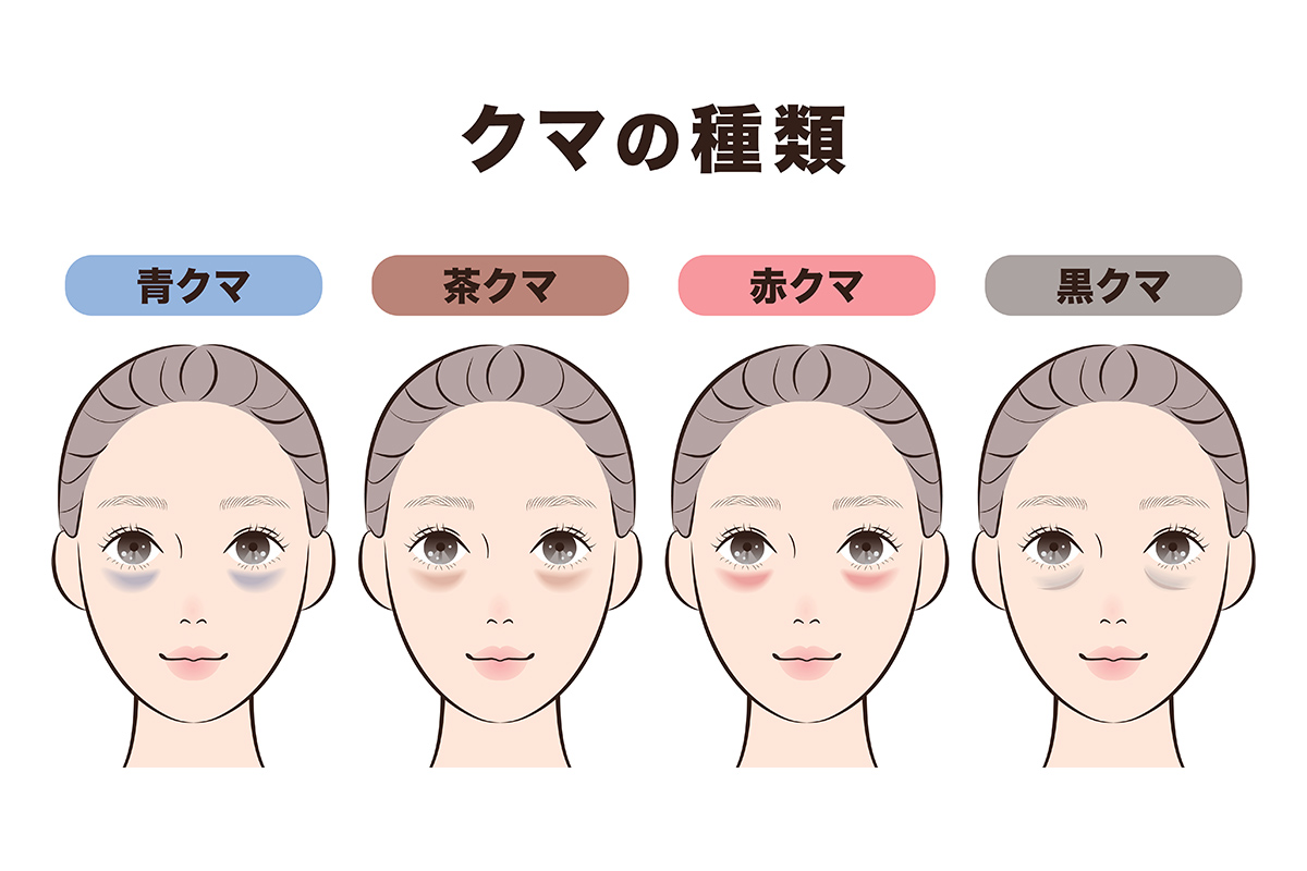1章. 目の下のクマは4種類