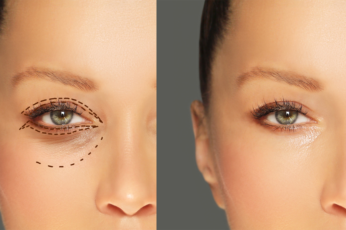 第2章 クマ取りの脂肪注入の種類