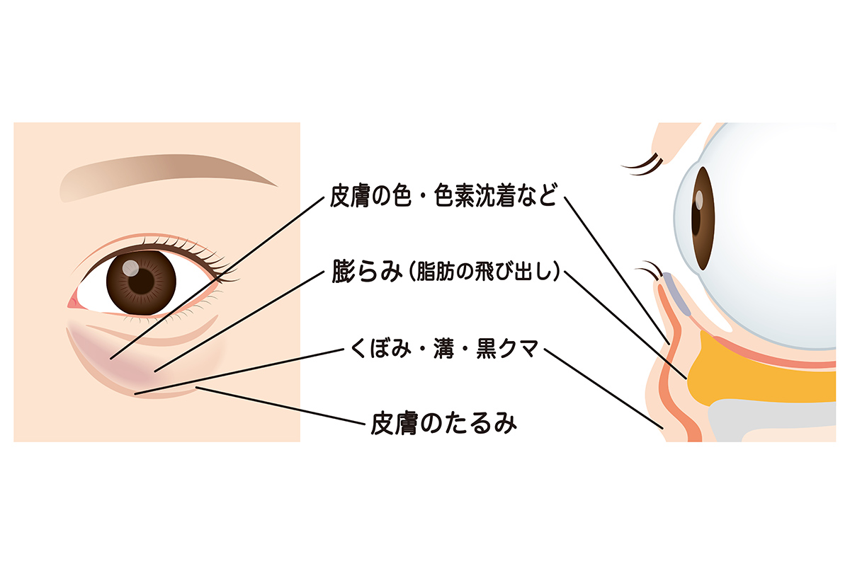 第1章 目の下のたるみ・膨らみの原因は？