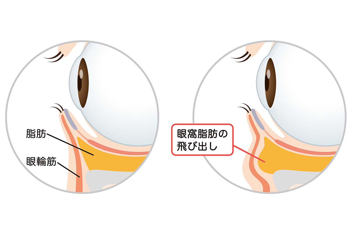 第3章 黒クマ（影クマ）が発生する原因