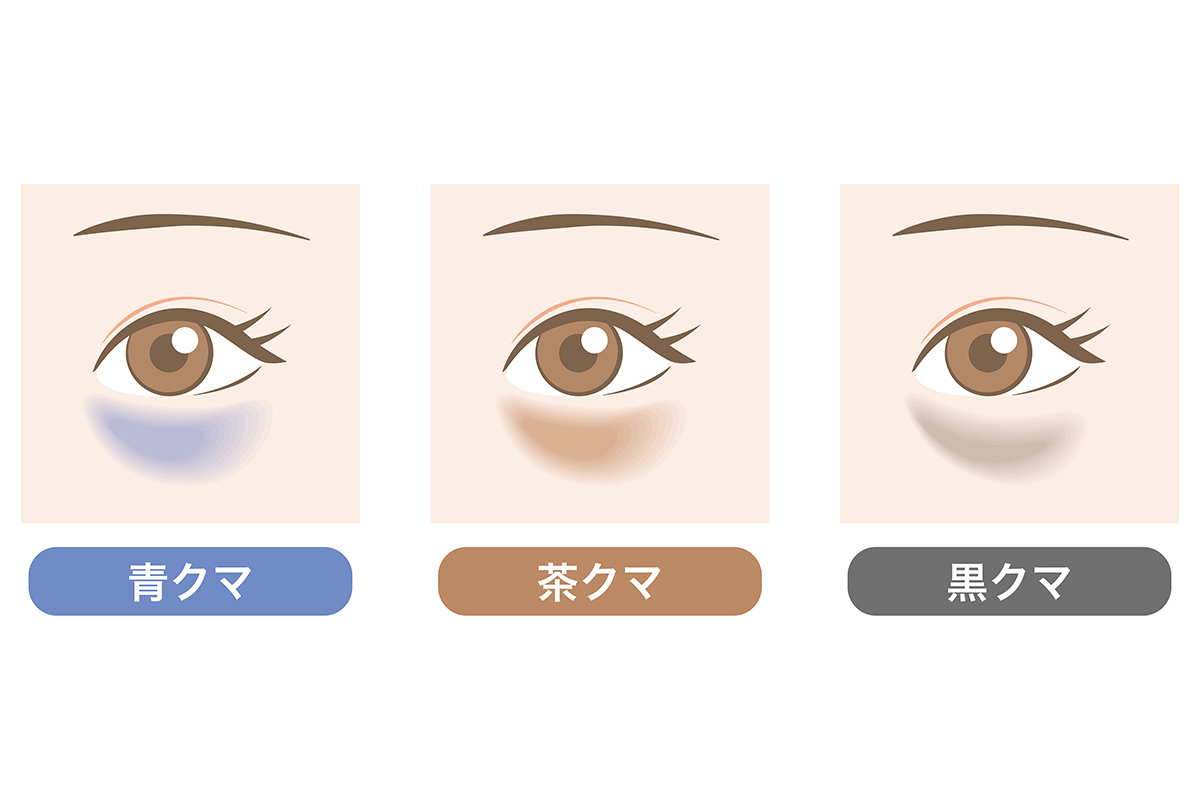 1-1. 目の周りの色素沈着＝「茶クマ」