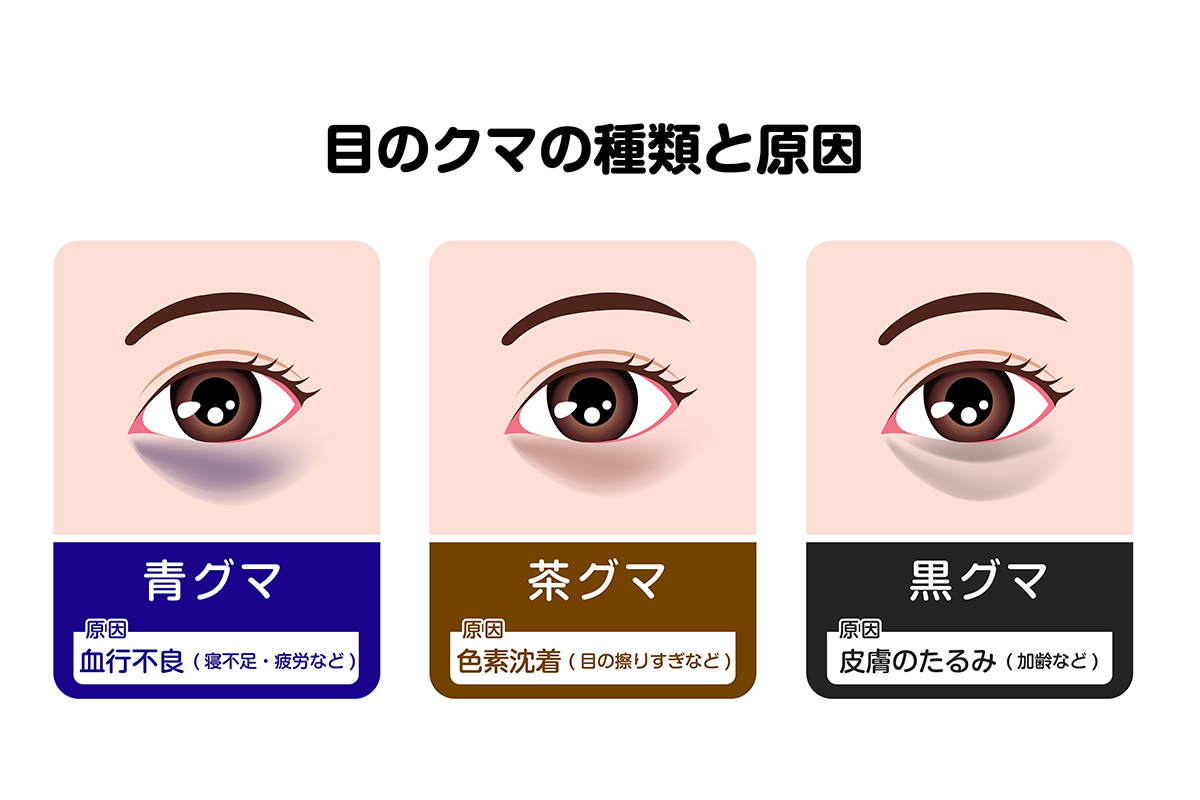 第1章 目の周りが黒くなる原因