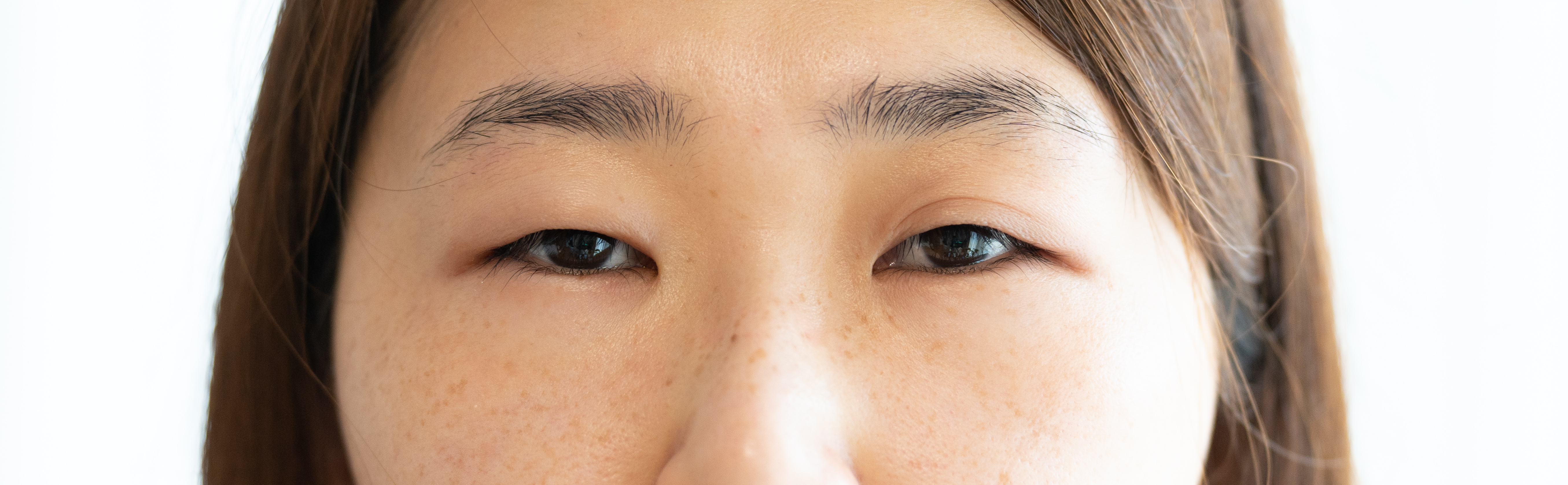 2-2. 表ハムラは裏ハムラより腫れやすい？