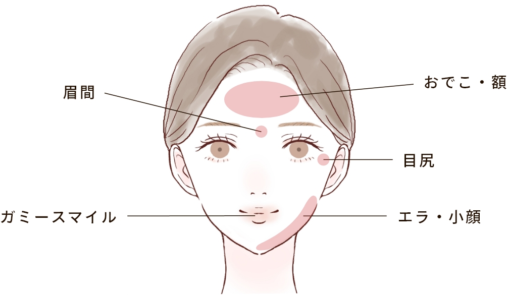 ボトックス注射の注入部位