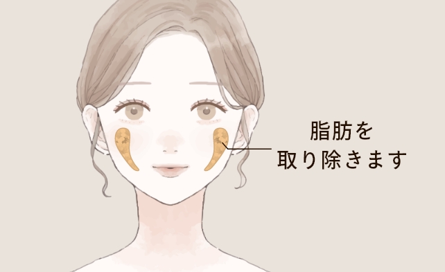 バッカルファットについて