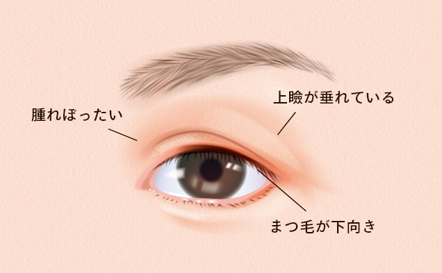 切開法（二重整形）とは