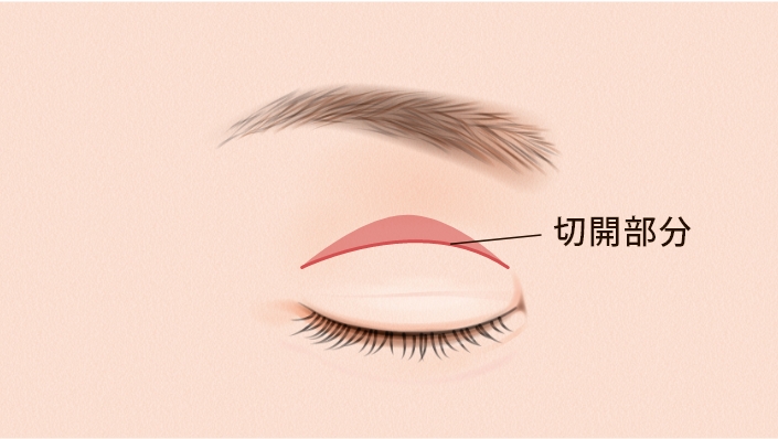 全切開法（まぶたの上のたるみ取り）