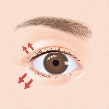 目尻切開・グラマラスライン