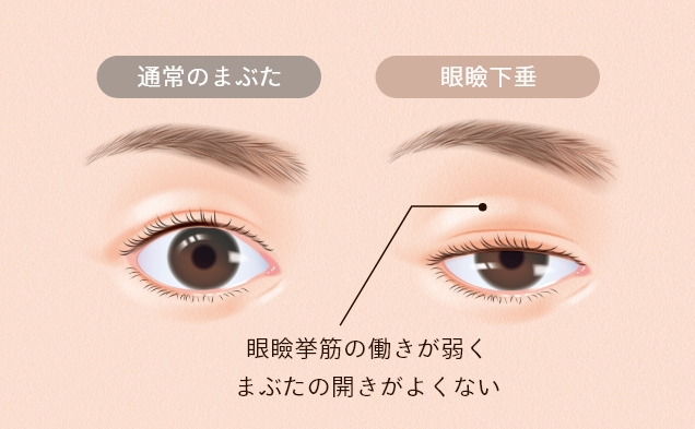 眼瞼下垂とは