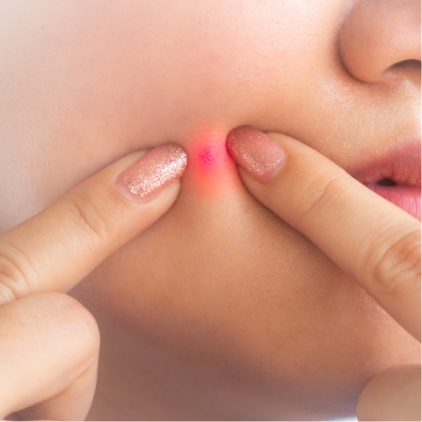 ニキビができにくい肌に