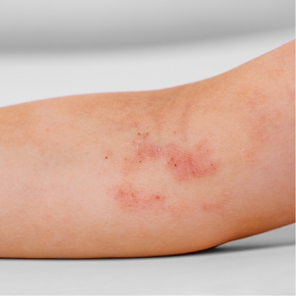 刺激に反応しにくい健康な肌へ