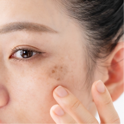 シミや肝斑の目立たない明るい肌へ