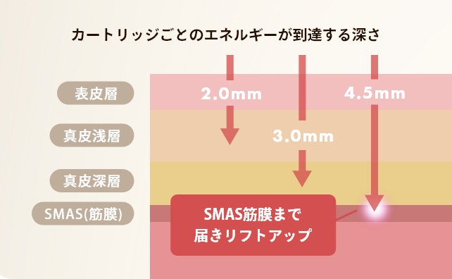 ウルトラフォーマーMPT