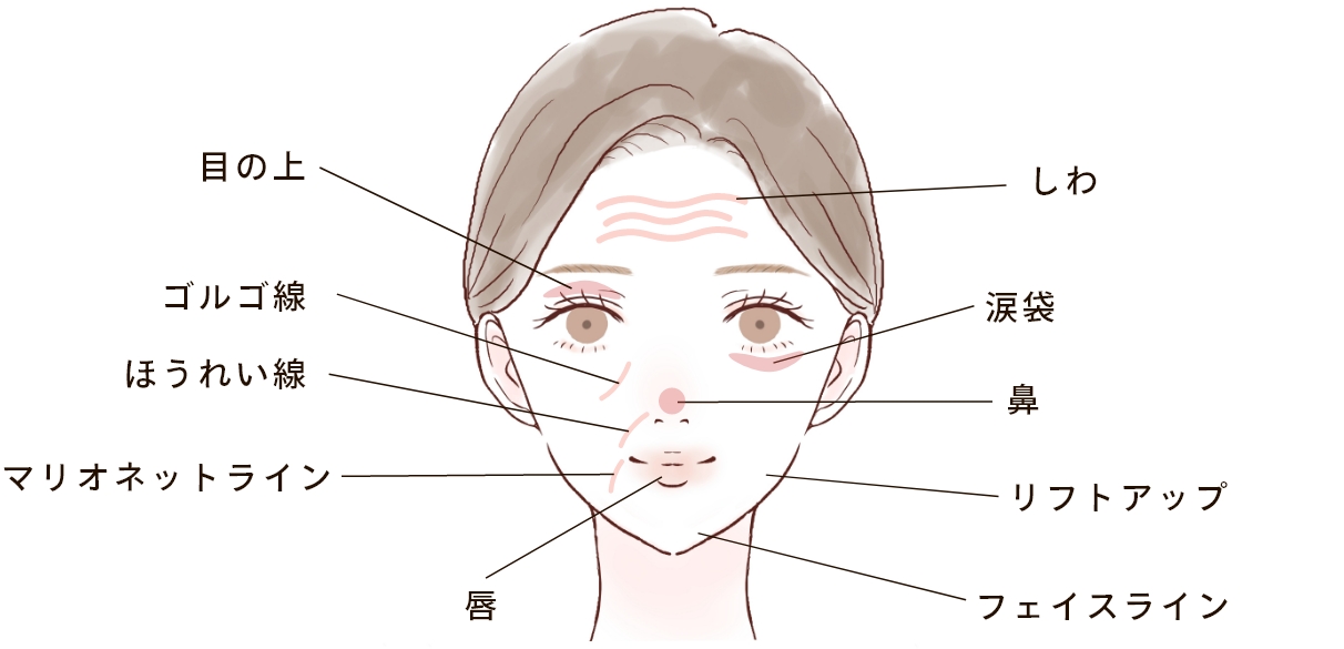 ヒアルロン酸注射の注入部位