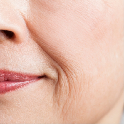 しわ・溝への注射