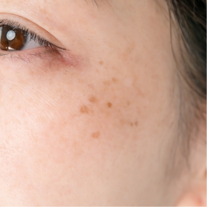 シミ・肝斑・美白