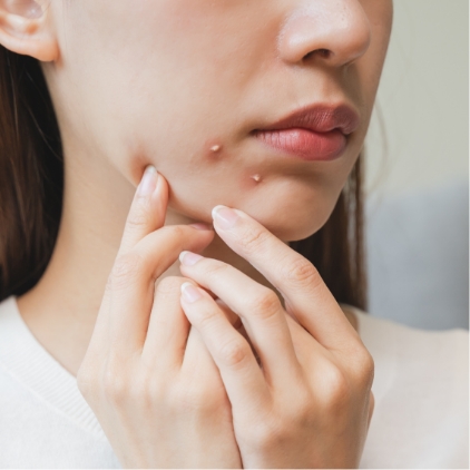 赤ら顔・ニキビ