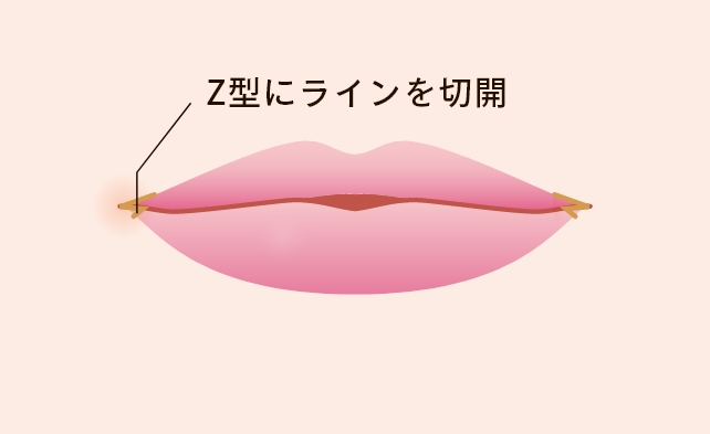 口角挙上について