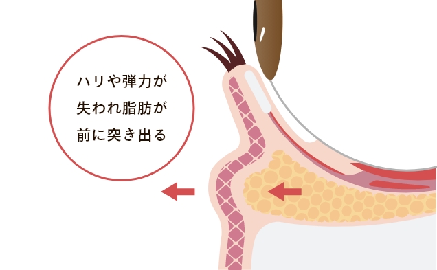 目の下が膨らむ原因