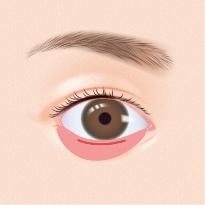 切らないクマ取り(経結膜脱脂法)