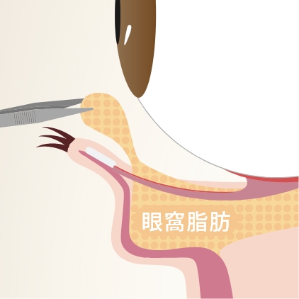 切らないクマ取り(経結膜脱脂法)