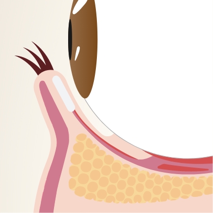 切らないクマ取り(経結膜脱脂法)