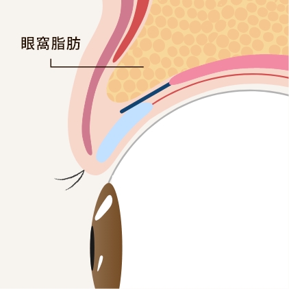 先天的に「眼窩（がんか）脂肪」が多い