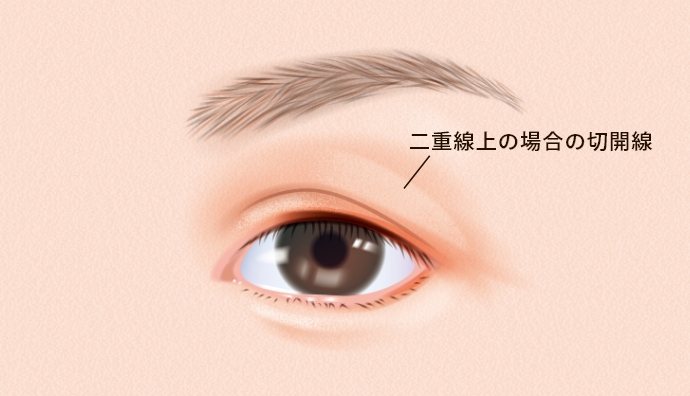 目の上のたるみ取り