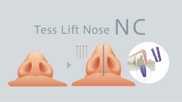 Tess lift Nose NC