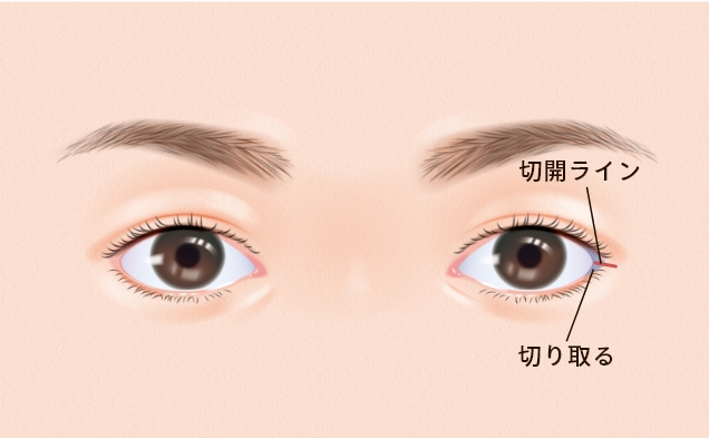 目尻切開について