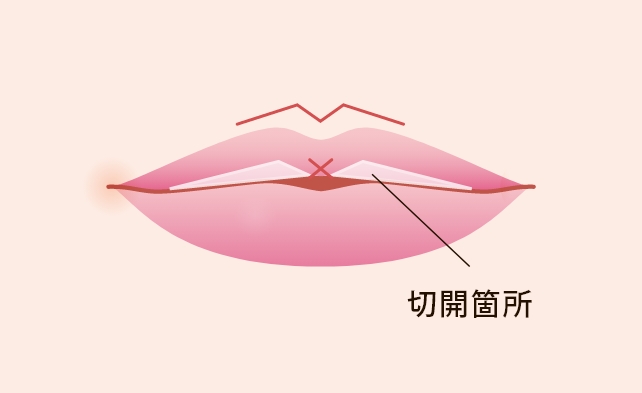 M字リップ形成について
