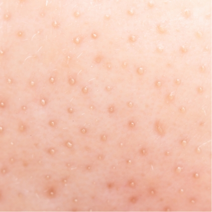 クレーター・毛穴・美肌治療