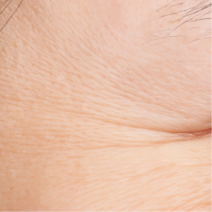 たるみの引き締め