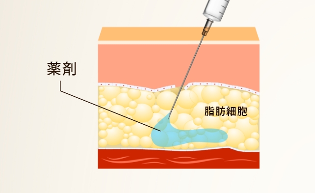 脂肪溶解注射について