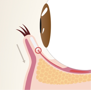 通した糸を縛り、瞼板を下げます。