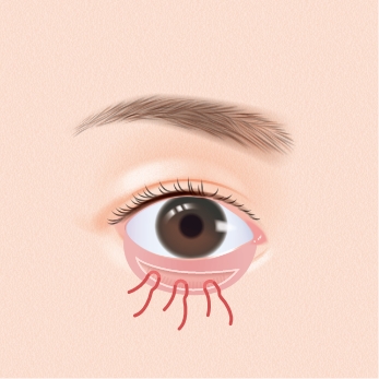 筋肉と結膜を縫合します。