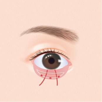 結膜を縫合します。