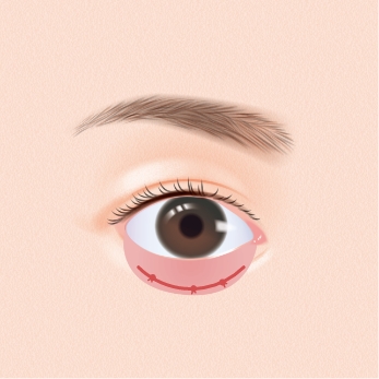 縫合した糸の結び目を、結膜の内側に埋め込み終了です。