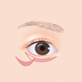 切開箇所の皮膚を切除します。