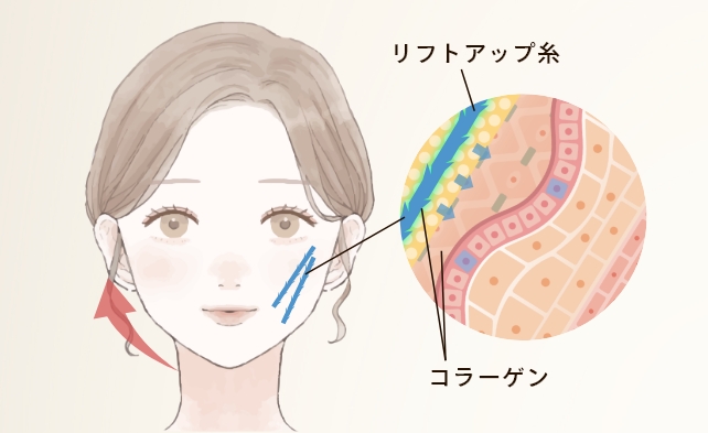 糸リフトについて