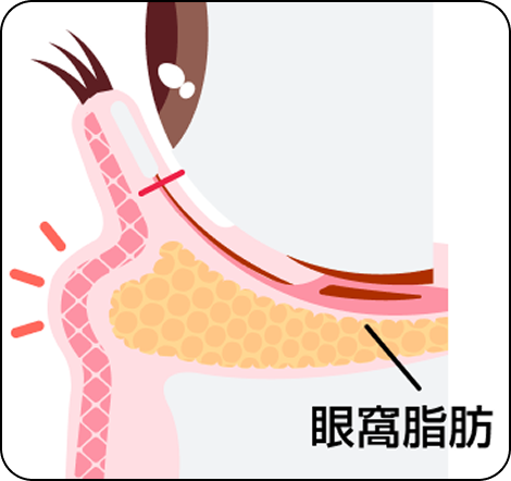 切らないクマ取り（裏ハムラ法）