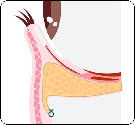 切らないクマ取り（裏ハムラ法）