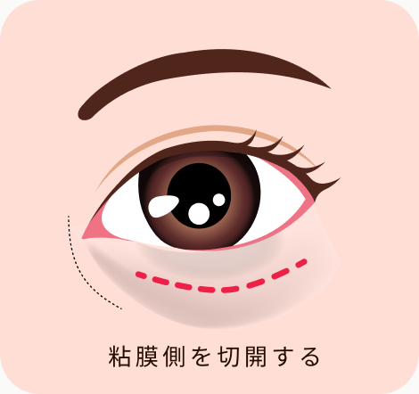 切らないクマ取り（裏ハムラ法）