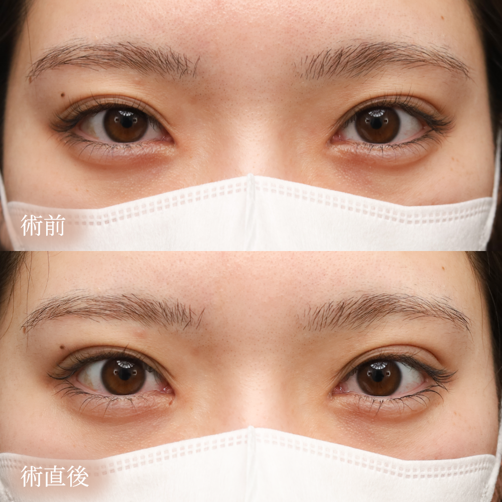 二重埋没法の術直前・直後比較